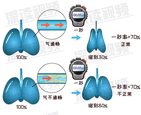 逆转慢阻肺最新技术，重塑呼吸自由新篇章